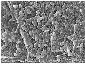 NGHIÊN CỨU ĐẶC ĐIỂM LÂM SÀNG VÀ TỶ LỆ BIOFILM TRÊN AMIDAN-VA CỦA BỆNH NHÂN ĐƯỢC CẮT AMIDAN-VA