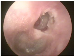 PHẪU THUẬT NỘI SOI MỞ THƯỢNG NHĨ TRONG BỆNH LÝ VIÊM THƯỢNG NHĨ CHOLESTEATOMA