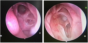 ĐÁNH GIÁ TÌNH TRẠNG NGÁCH XOANG TRÁN QUA NỘI SOI VÀ CT.SCAN MŨI XOANG SAU PHẪU THUẬT NỘI SOI MŨI XOANG CÓ MỞ NGÁCH TRÁN