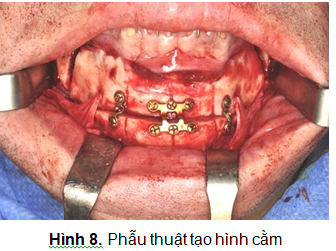 PHẪU THUẬT CHỈNH HÌNH XƯƠNG CHO ĐIỀU TRỊ NGỪNG THỞ KHI NGỦ