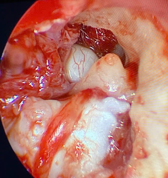 CHOLESTEATOMA NGUYÊN PHÁT: ĐẶC ĐIỂM LÂM SÀNG, CHẨN ĐOÁN, ĐỐI CHIẾU PHẪU THUẬT VỚI MÔ BỆNH HỌC  VÀ PHÂN LOẠI