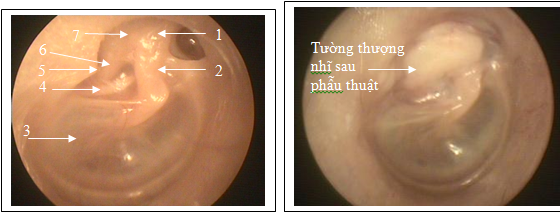 ĐÁNH GIÁ KẾT QUẢ TẠO HÌNH TƯỜNG THƯỢNG NHĨ