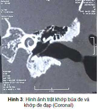 NGHIÊN CỨU ĐẶC ĐIỂM LÂM SÀNG, THÍNH LỰC VÀ CẮT LỚP VI TÍNH 128 DÃY CỦA TỔN THƯƠNG XƯƠNG CON TRONG CHẤN THƯƠNG XƯƠNG THÁI DƯƠNG