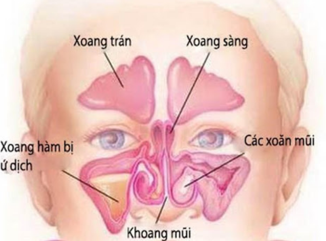 PHÂN ĐỘ VIÊM MŨI XOANG -Staging in Rhinosinusitis